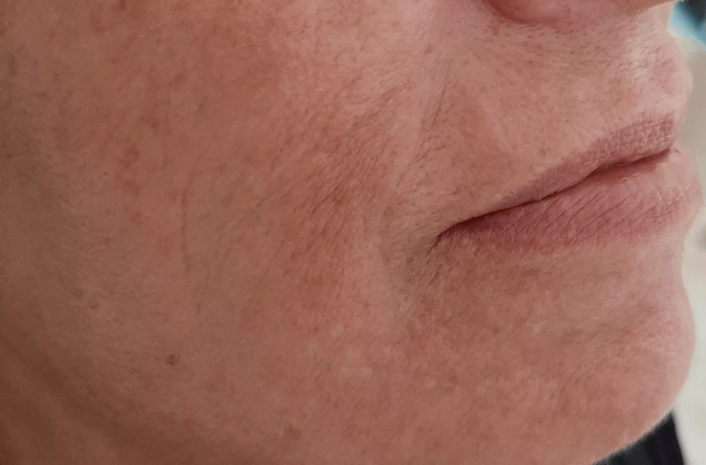 Risultato della pelle del viso Dopo il trattamento di Biobotulino