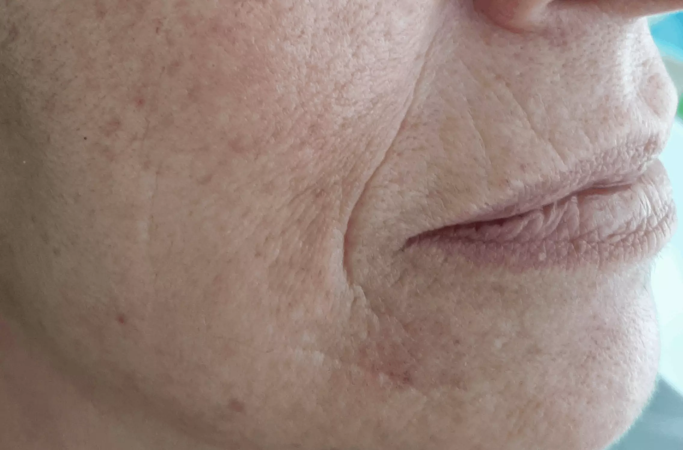 Pelle del viso Prima del trattamento di Biobotulino