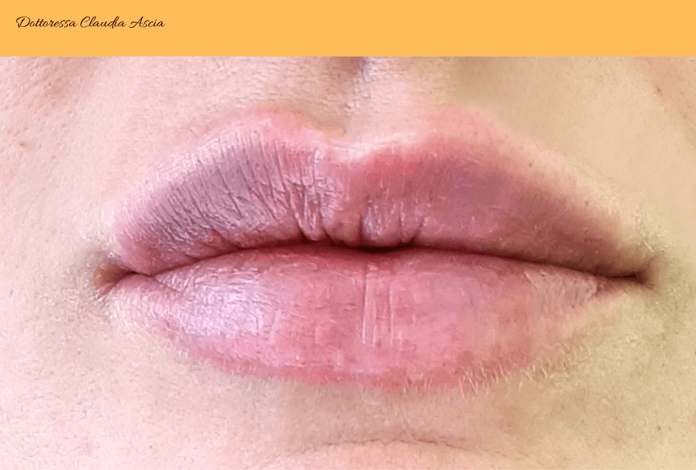 Risultato Filler Labbra Dopo il trattamento