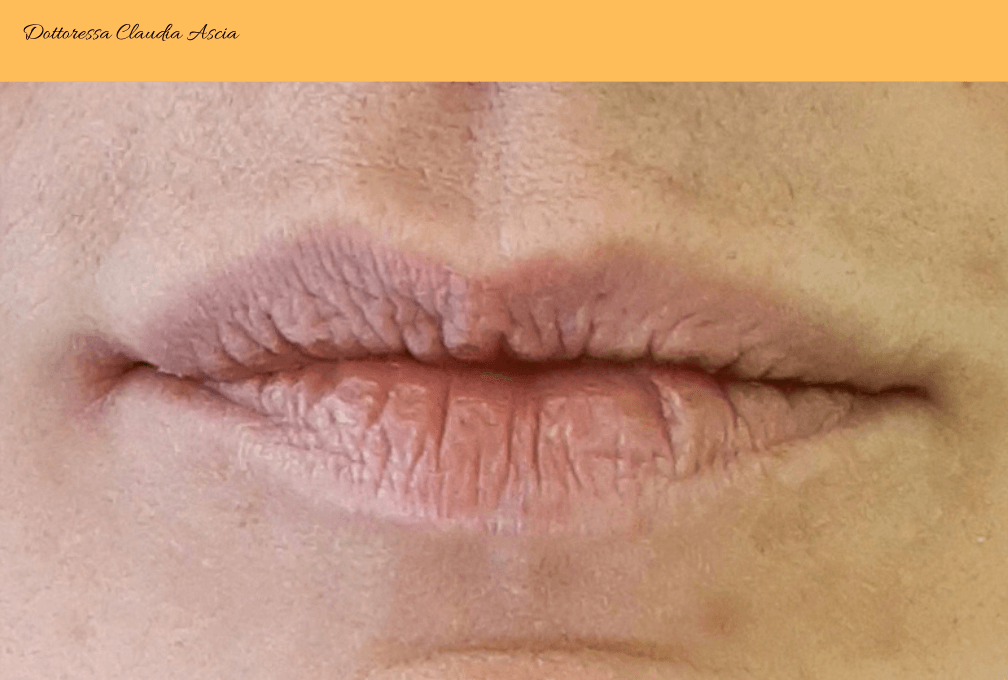 Situazione Filler Labbra Prima del trattamento