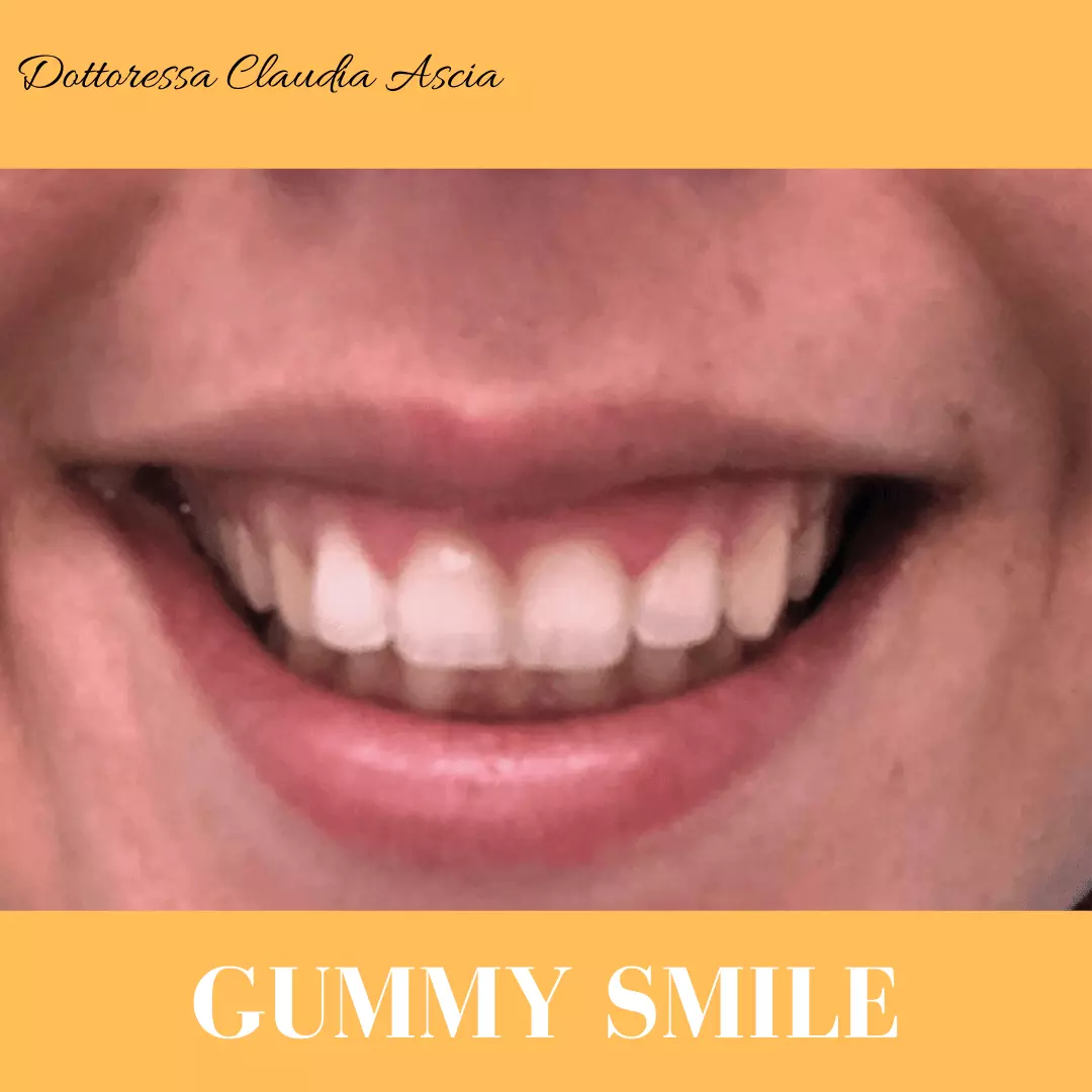 Risultato Correzione Gummy Smile Dopo il trattamento