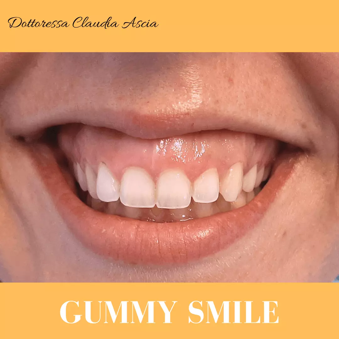 Sorriso Gengivale Prima del trattamento
