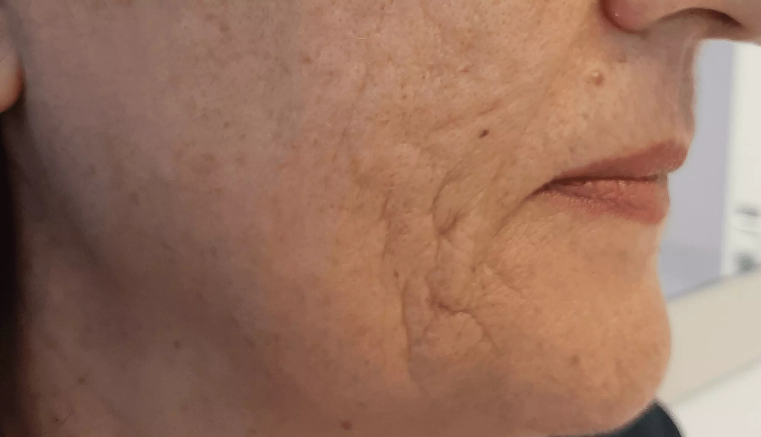 Pelle del viso visibilmente rigenerata dopo il Needling