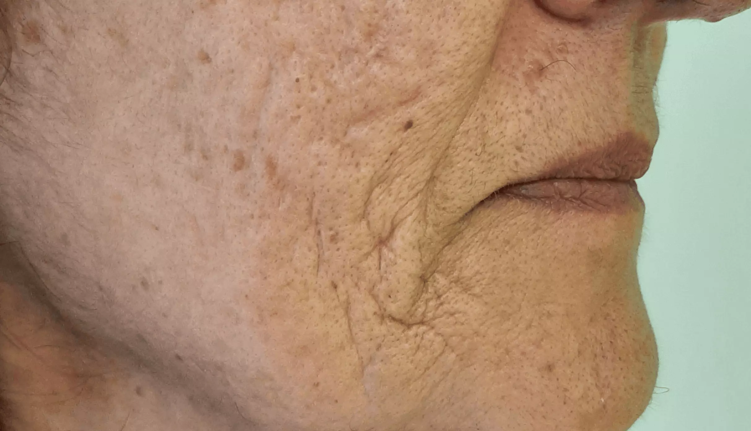 Pelle del viso prima del trattamento di Needling