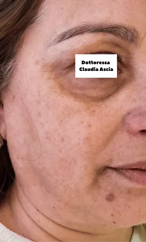 Risultato dopo il trattamento di radiofrequenza