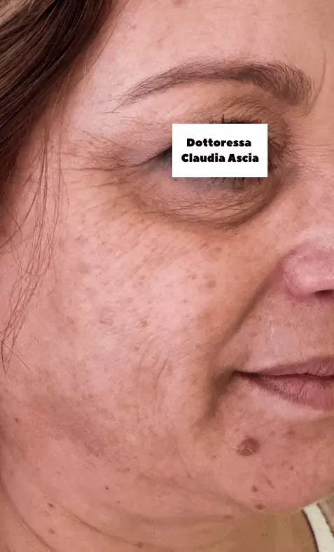 Pelle prima del trattamento di radiofrequenza