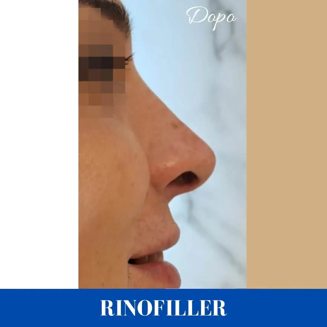 Risultato Rinofiller Dopo il trattamento