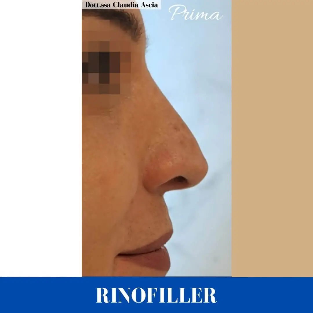 Profilo del naso Prima del Rinofiller