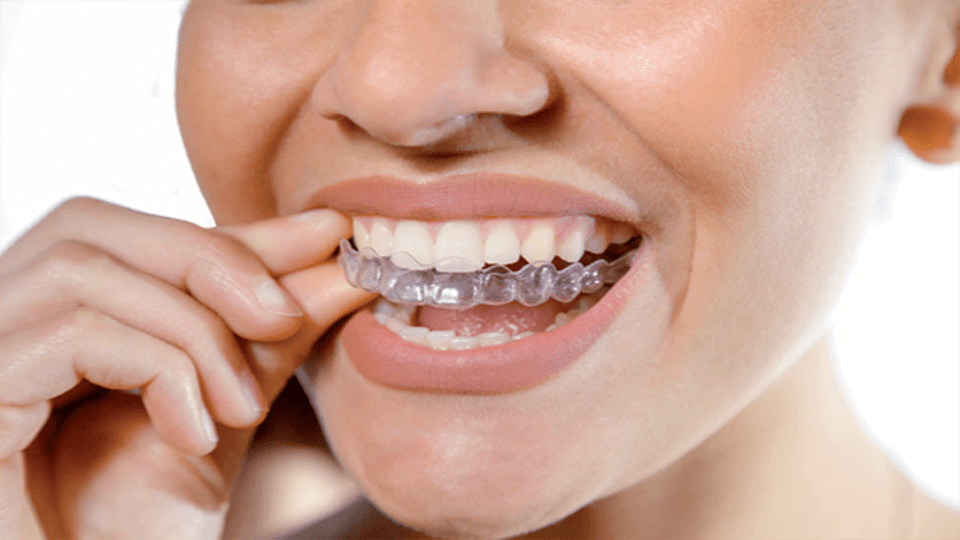 Sorriso perfetto con allineatori invisibili
